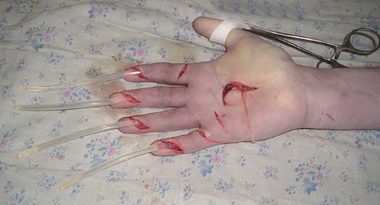 Тяжелые повреждения кисти и пальцев